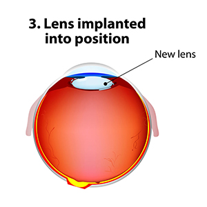 cataract surgery 03